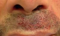 Trasplante de barba realizado en la cicatriz de labio leporino