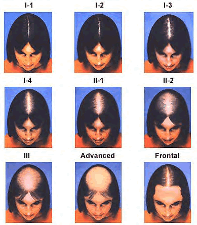 Clasificación de la alopecia de patrón femenino en un injerto capilar