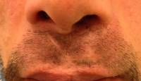 Cicatriz en labio leporino previo al trasplante de barba
